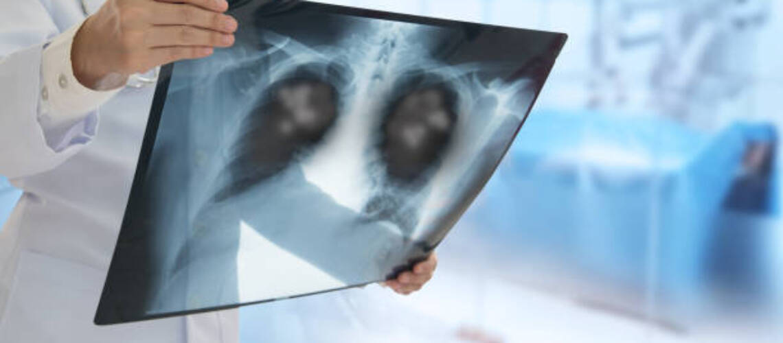 Doctor looking Pneumonia patient x-ray film for diagnose 
Emphysema,Pneumonia,Inflamed lung.